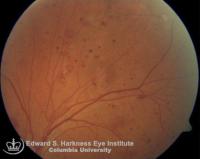 Dot and Blot Hemorrhages